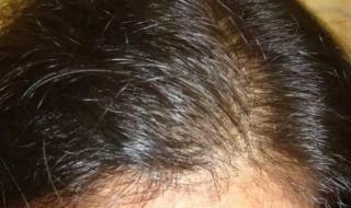 我小孩今年1岁半了,怎么头发特别稀少,特别是头顶上面,怎么办 婴儿头发稀少怎么办